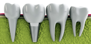 implant classic 300x144 - Этапы установки импланта