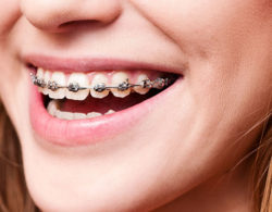 Ортодонтия brackets 03 250x195 - Ортодонтия
