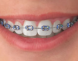 Ортодонтия brackets 07 250x195 - Ортодонтия