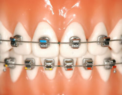 bezligaturnye braces 01 250x195 - Безлигатурные брекеты