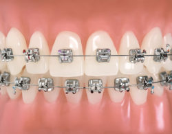 bezligaturnye braces 02 250x195 - Безлигатурные брекеты