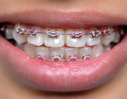 bezligaturnye braces 05 250x195 - Безлигатурные брекеты