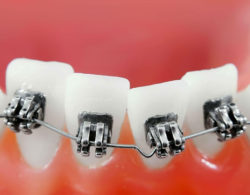 bezligaturnye braces 06 250x195 - Безлигатурные брекеты