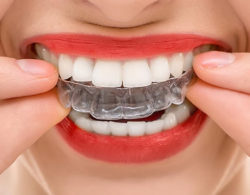invisible braces 08 250x195 - Каппы Invisalign