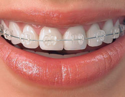 invisible braces 09 250x195 - Невидимые брекеты