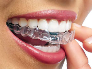 kappy invisalign 300x225 - Каппы Invisalign