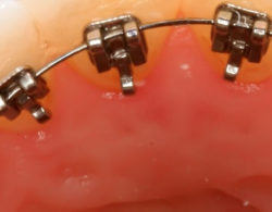 lingual braces 02 250x195 - Лингвальные брекеты
