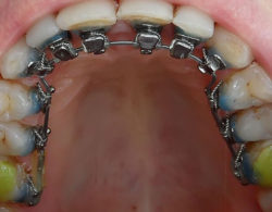 lingual braces 03 250x195 - Лингвальные брекеты