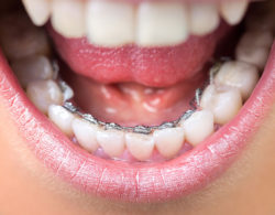 lingual braces 05 250x195 - Лингвальные брекеты