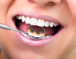 lingual braces 06 250x195 - Лингвальные брекеты