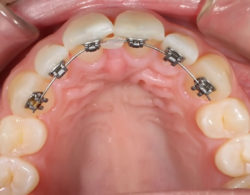 lingual braces 07 250x195 - Лингвальные брекеты