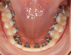 lingual braces 08 250x195 - Лингвальные брекеты