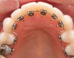 lingual braces 09 250x195 - Лингвальные брекеты