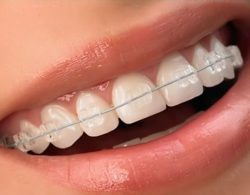 sapphire braces 01 250x195 - Сапфировые брекеты