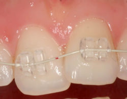 sapphire braces 02 250x195 - Сапфировые брекеты