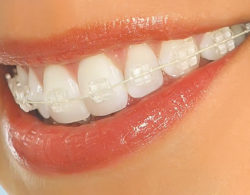 sapphire braces 03 250x195 - Сапфировые брекеты