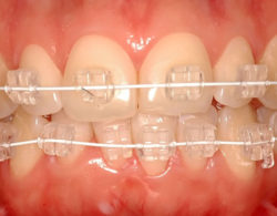 sapphire braces 04 250x195 - Сапфировые брекеты