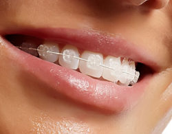sapphire braces 06 250x195 - Сапфировые брекеты