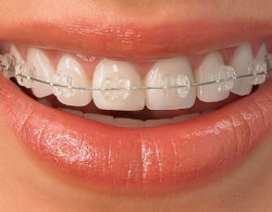 sapphire braces 07 250x195 - Сапфировые брекеты