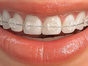 sapphire braces 300x225 - Сапфировые брекеты