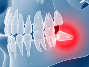 retinirovanniye zuby 01 300x225 - Удаление ретинированного дистопированного зуба
