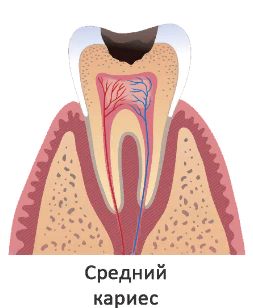 VUTlb5W - Лечение кариеса