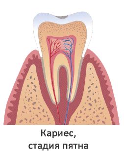dZfTa60 - Лечение кариеса