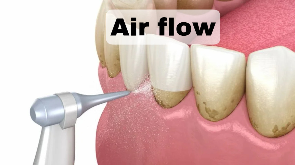 prof chistka zubov air flow - Air Flow