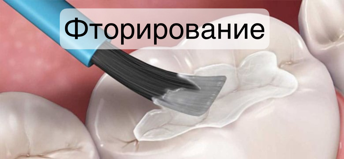 prof chistka zubov ftorirovanie - Фторирование зубов