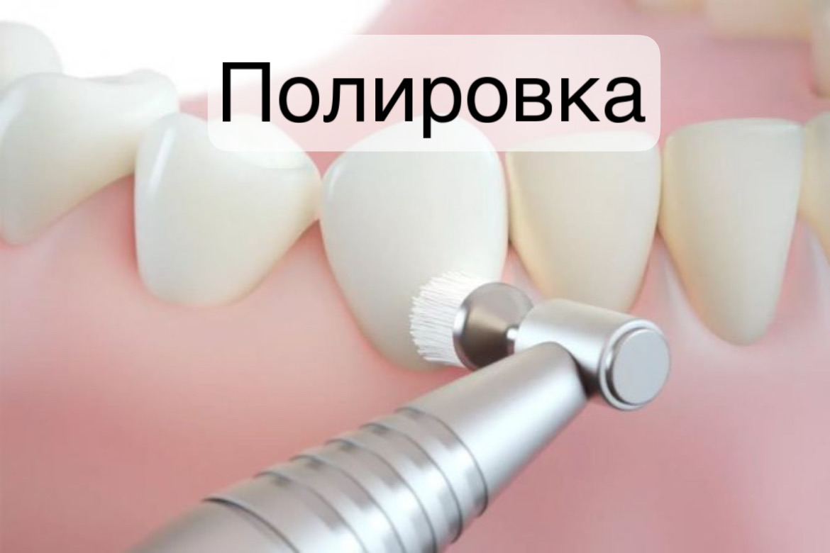 prof chistka zubov polirovka - Полировка зубов
