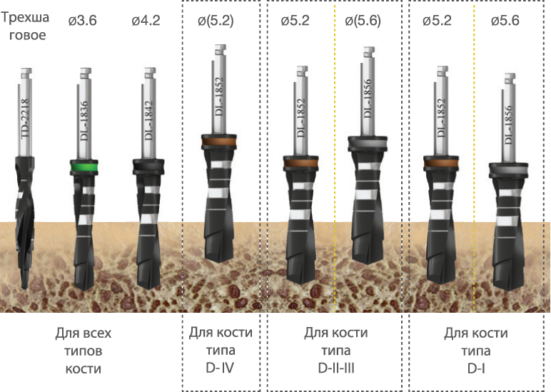 implantat touareg s 6.0 boring - Имплантат ADIN - TOUAREG S